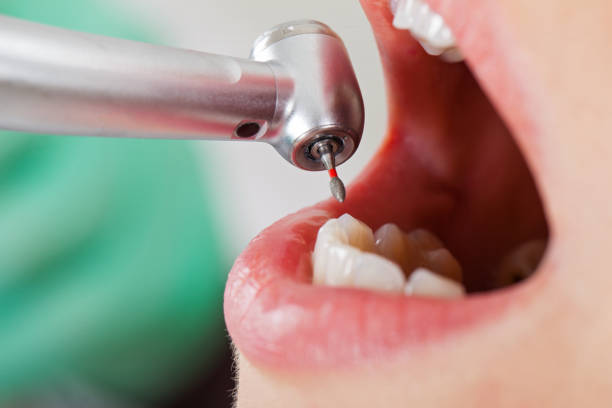 Best Dentist for Tooth Abscess  in Stanton, MI